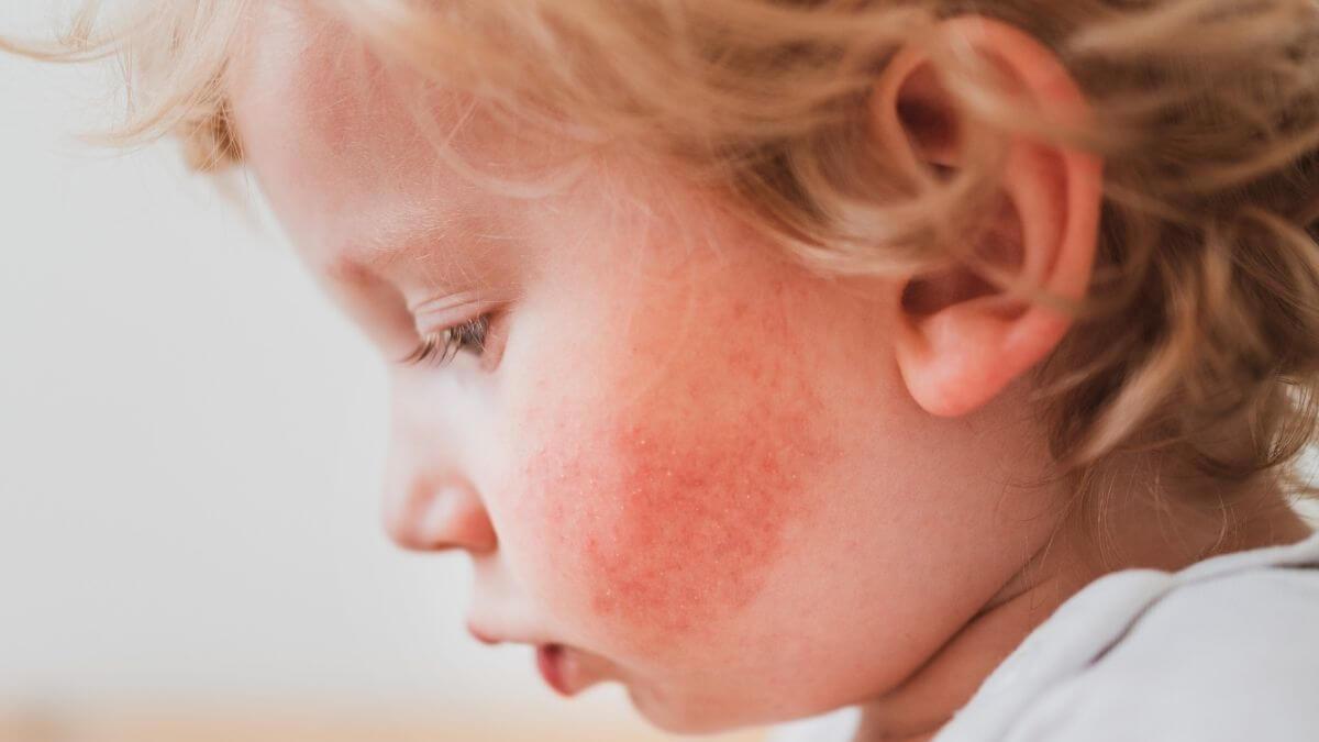 Baby wakes up deals with very red cheeks